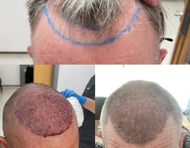 Elite Hair Restoration FUE Hair Transplant Results