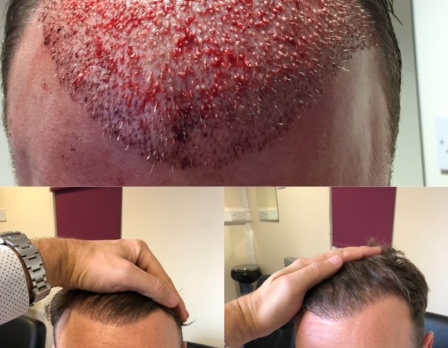 Elite Hair Restoration FUE Hair Line Post Surgery Results