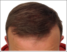Elite Hair Restoration FUE 1750 Grafts 12 Months Post Op Results Photo