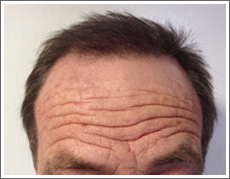 Elite Hair Restoration FUT 2,500 Grafts Post OP Results Photo